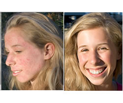 Acne Free In 3 Days User