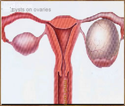 Natural Cysts on Ovaries Cure