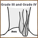 Grade 3 and Grade 4 External haemorrhoids