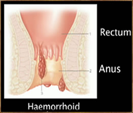 What are hemroids natural tretment?
