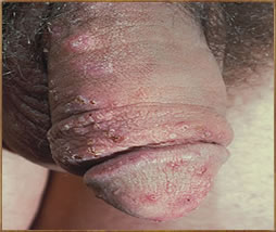 Herpes simplex virus pictures - HSV infection