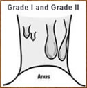 Grade 1 and Grade 2 Internal haemorrhoids