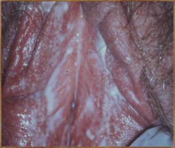 Photos of cottage cheese-like discharge vaginal infection