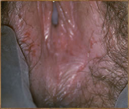 Photos of diagnosis of crohn's disease
