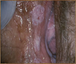 Photos of microinvasive lesion of the vulva