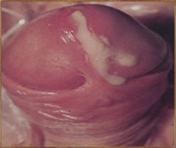 Photos of gonococcal urethritis in penis