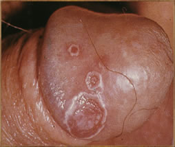 Pictures of Reiter's disease in penis